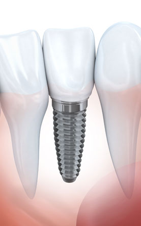 Dental Implants