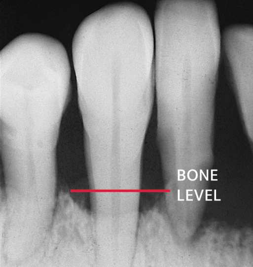 X-ray showing periodontal bone loss.