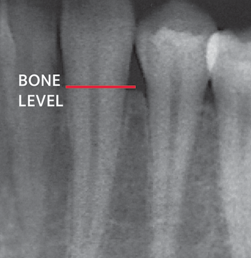 X-ray showing supporting bone.