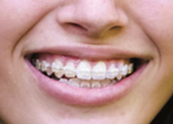 Braces and Orthodontics