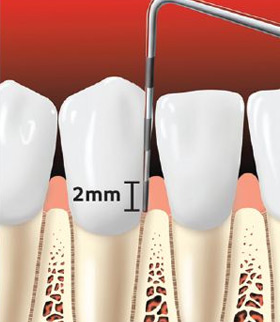 Periodontal probe of healthy gums.