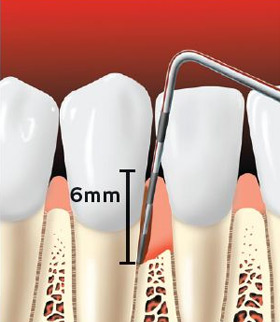 Periodontal probe showing a pocket forming between the tooth root and the gums.